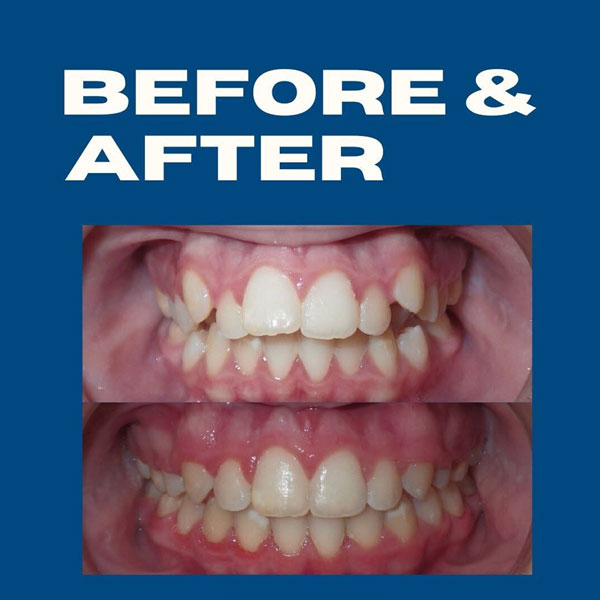 baxter-orthodontics-patient-before-and-after-downtown-gardner-ks